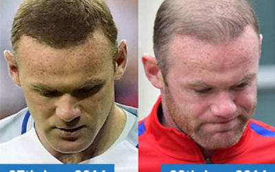 Is Wayne Rooney using Hair Loss Concealers?