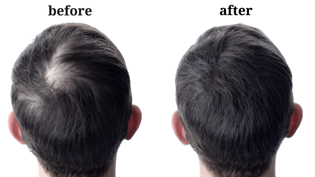 before_after_bald_spot_biothk